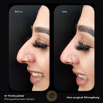 Non-surgical Rhinoplasty - 3